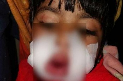 3 year old baby gets injured due to firecracker burst in mouth